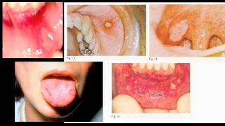 aphthous stomatitis  canker sores [upl. by Renault]