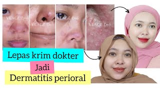 PERJUANGAN SEMBUH DARI DERMATITIS PERIORAL  Krim Etiket Biru  CREAM PEMUTIH  By Vapinka Makeup [upl. by Nerha]