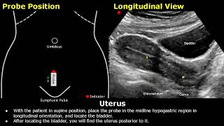 Uterus amp Ovaries Ultrasound Probe Positioning  Transducer Placement  Gynecological USG Scanning [upl. by Hartzell]