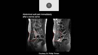 MRI of the Hip Part 4 – Hip Trauma [upl. by Enirehtac]