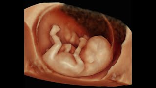 How to Perform 3D Scan of the Baby at 12 Weeks of Pregnancy [upl. by Herzel]