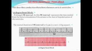 Principles of ECG quotelectrocardiographyquot Part 11 [upl. by Noellyn]