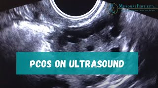 PCOS Sonogram and Discussion [upl. by Placidia]