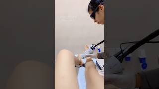 Female Unwanted hair removal by laserlaser hairtransformation unwantedhairremoval hairs [upl. by Vipul]