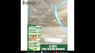 Vitiligo Removal cream [upl. by Verbenia]