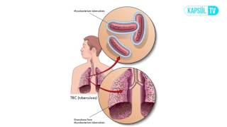 Verem Tüberküloz Nedir Neden Olur [upl. by Arnoldo]
