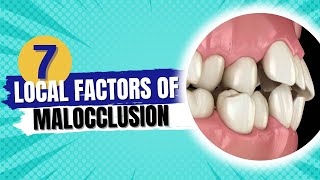 Etiology of malocclusion quotLocal factors of malocclusionquot  Orthodontics [upl. by Gambrill644]