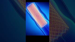 3D Animation of Angioplasty Heart Procedure Medical Animation Explained [upl. by Silverts]