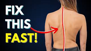 How To Treat Scoliosis amp Other Posture Issues [upl. by Audun]