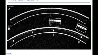 LoVC Course on Therapeutic Corneal Refractive Surgery Part 1 of 6 Diagnostics [upl. by Puett894]