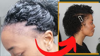 03 ASTUCES CONTRE LALOPÉCIE et TEMPES DÉGARNIES sur cheveux afro et cheveux naturels [upl. by Lierbag]