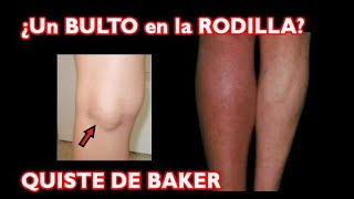 ¿Qué es ese bulto detrás de mi RODILLA El Quiste de BAKER [upl. by Azeel]