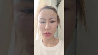 After mesotherapy 😂😂😂mesotherapy skincare aginggorgeously skincareroutine [upl. by Leahsim]