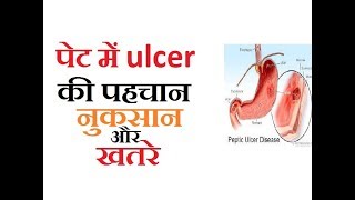 अमाश्य या stomach और पेट की आंत में अल्सर या घाव के 10 खतरनाक संकेत लक्षण और नुकसान [upl. by Yelyk723]