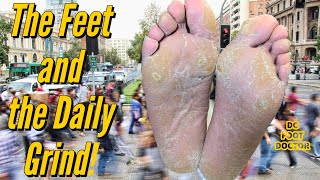 The Feet and the Daily Grind Trimming Severe Calluses [upl. by Eanad]