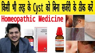 Cyst  Homeopathic Medicine for All type of Cyst  Remove 100 [upl. by Willetta793]