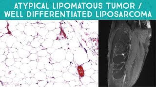 Well differentiated liposarcoma  quotAtypical lipomatous tumorquot mimicking lipoma Oregon Case 13 [upl. by Eadmund]