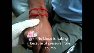 Cannulation Technique Important Tips [upl. by Ahseekat]