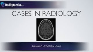 Cases in Radiology Episode 1 neuroradiology CT MRI [upl. by Yrrap737]