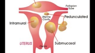 Myoma Uterine Fibroids  What is Myoma Causes Symptoms and Treatment for Myoma [upl. by Etnahs]