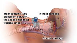 What is a Tracheostomy  A Guide to the Artificial Trachea [upl. by Kelwen]