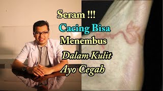 Cacing Masuk Ke Dalam Kulit Cutaneous Larva Migrans CLM [upl. by Nybbor836]