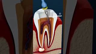 Root canal treatment for infected tooth STEP BY STEP rootcanal implantprocedure infectedtooth [upl. by Natassia14]