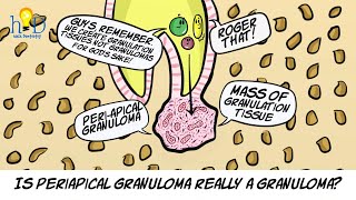 What is periapical granuloma [upl. by Jessica]