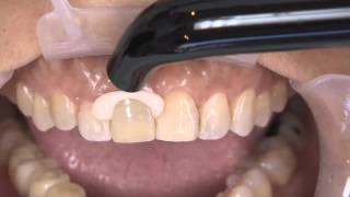 How to Complete an Anterior Dental Restoration with Kerrs Nexus RMGI [upl. by Emanuele]