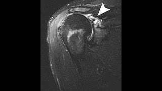 Rotator Cuff Arthropathy [upl. by Nnagrom]