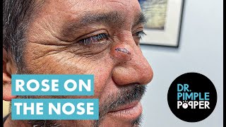 Dr Pimple Popper Opens A Rose on the Nose [upl. by Wind470]