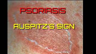 Auspitzs sign demonstrationGrattage testpsoriasis [upl. by Brubaker]