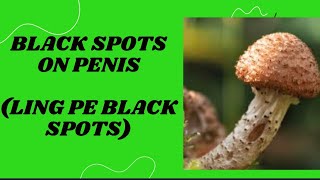 लिंग पे काले दाने । black spots on penis  melanosis [upl. by Acir]