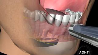 интрасептальная анестезияintraseptal anesthesia [upl. by Hilton]