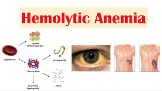 Hemolytic Anemia [upl. by Efron]