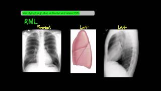 Identifying Lung Lobes on Frontal and Lateral Chest XRays UndergroundMed [upl. by Nnyliram]