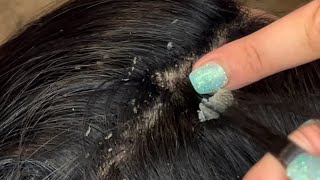 Picking and combing through dandruff psoriasis scalp scratching flare up [upl. by Ydisac]