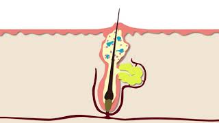 How Acne Develops  Acne Support [upl. by Aramak]