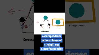 ARC abnormal retinal correspondence [upl. by Racso753]