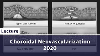 Choroidal Neovascularization 2020 [upl. by Eiramanitsirhc]