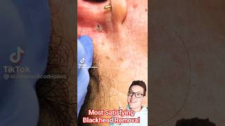 The Perfect BLACKHEAD REMOVAL The Best I Have Seen shorts [upl. by Nwonknu]