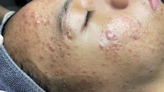 ACNE TREATMENT VU QUYNH MI  Perennial Blackheads On Boy Face 2024FULL [upl. by Eiramnna]