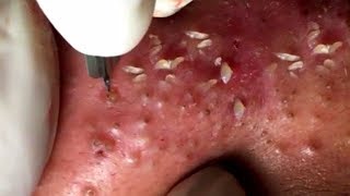 How To Remove Blackheads And Whiteheads On Face Easy 120 ✦ Dr Laelia ✦ [upl. by Arahas]