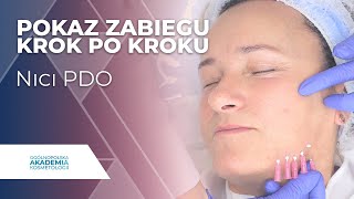 Nici PDO na twarzy  POKAZ ZABIEGU KROK PO KROKU [upl. by Rudyard]