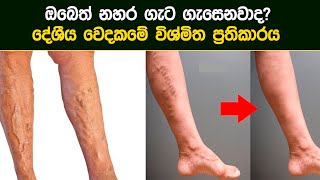 නහර ගැට ගැසීමට ආයුර්වේද ප්‍රතිකාර  nahara gata gasima  Ayurvedic Treatment  20220308 [upl. by Heman]