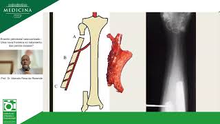 Enxerto periosteal vascularizado  Uma nova fronteira no tratamento das perdas ósseas [upl. by Virgin726]