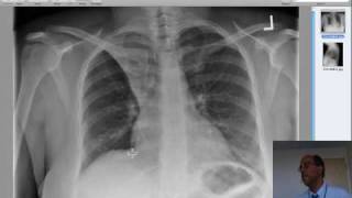 right upper lobe collapse due to mucous plug in an asthmatic [upl. by Aicilla174]