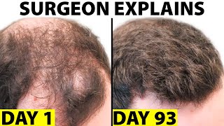 Oral Minoxidil  A Better Hair Loss Treatment [upl. by Agni]