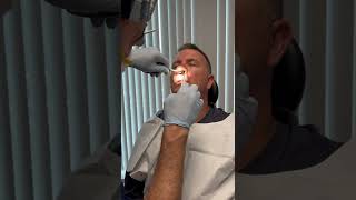 Nasal splint removal one week after Septoplasty [upl. by Ailedamla828]