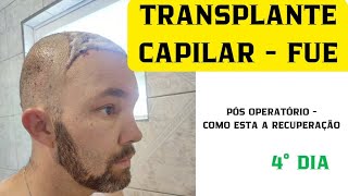 TRANSPLANTE CAPILAR  TÉCNICA FUE 4° DIA PÓS OPERATÓRIO [upl. by Chi933]